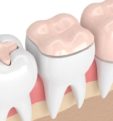 Вкладка на зуб – это современное решение для восстановления зуба
